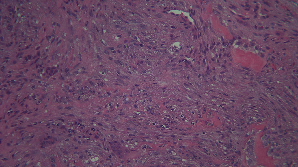 Histology-slide-showing-clusters-of-foreign-body-type-giant-cells-in-a-hemorrhagic-and-well-vascularized,-fibroblastic,-loosely-arranged-stroma-with-lymphocytes,-plasma-cells,-histiocytes,-and-osteoid-trabeculae-distributed-throughout.