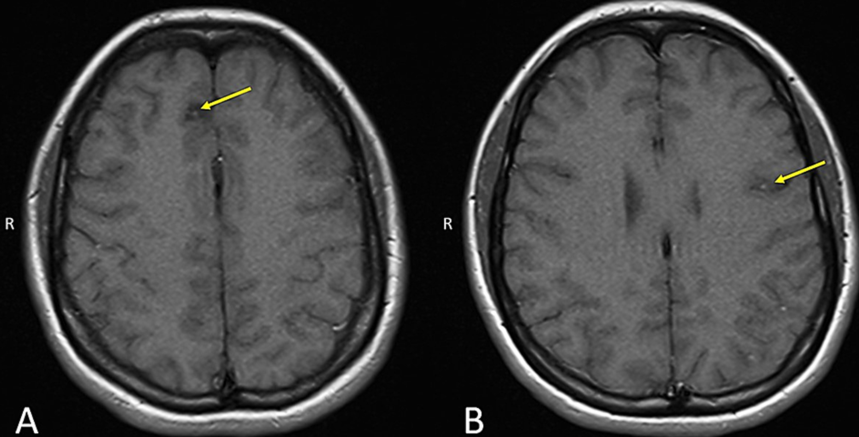 neurocysticercosis