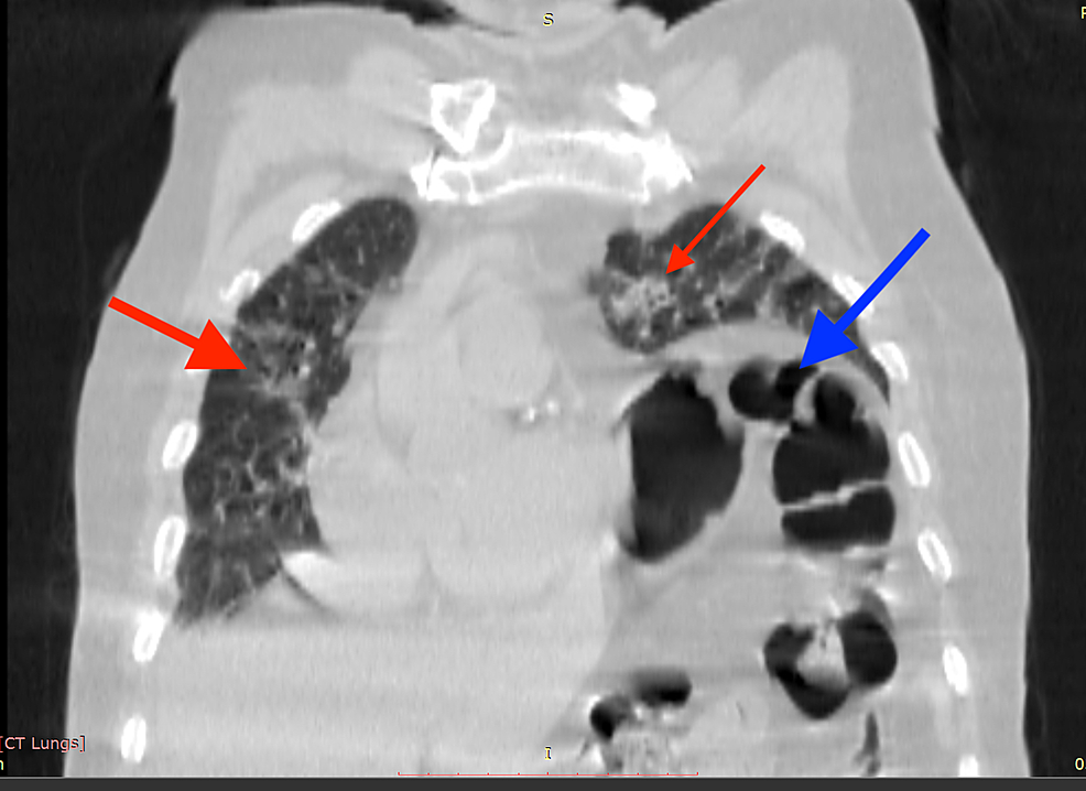 Cureus Unilateral Diaphragmatic Paralysis in a Patient With COVID19