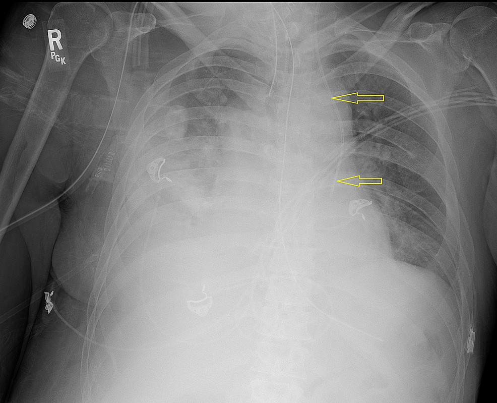 Chest-x-ray-confirming-the-placement-of-the-central-venous-access-line.-The-line-(marked-by-yellow-arrows)-does-not-take-the-expected-course-toward-the-right-side-of-the-heart.
