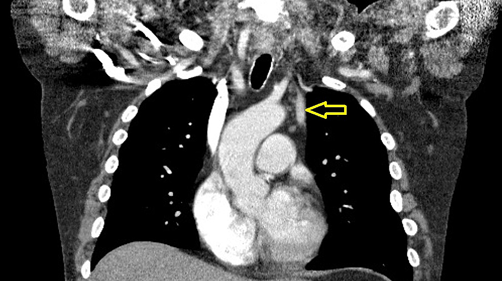 Chest-computed-tomography-(CT)-scan-(coronal-view)-with-contrast-performed-on-a-prior-admission-confirming-the-presence-of-a-duplicated-superior-vena-cava-(SVC)-(marked-by-yellow-arrow)-draining-into-the-coronary-sinus.