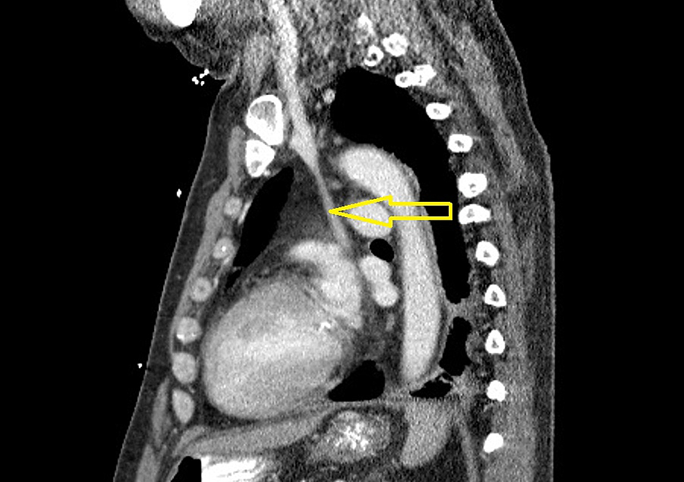 Chest-computerized-tomography-(CT)-scan-(sagittal-view)-with-contrast-performed-on-a-prior-admission-confirming-the-presence-of-a-duplicated-superior-vena-cava-(SVC)-(marked-by-yellow-arrow)-draining-into-the-coronary-sinus.