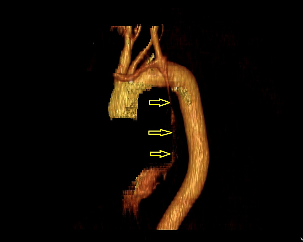 Three-dimensional-(3D)-reconstruction-of-the-patient’s-vasculature,-highlighting-the-presence-of-the-duplicated-superior-vena-cava-(SVC)-(marked-by-yellow-arrows)-draining-into-the-coronary-sinus.