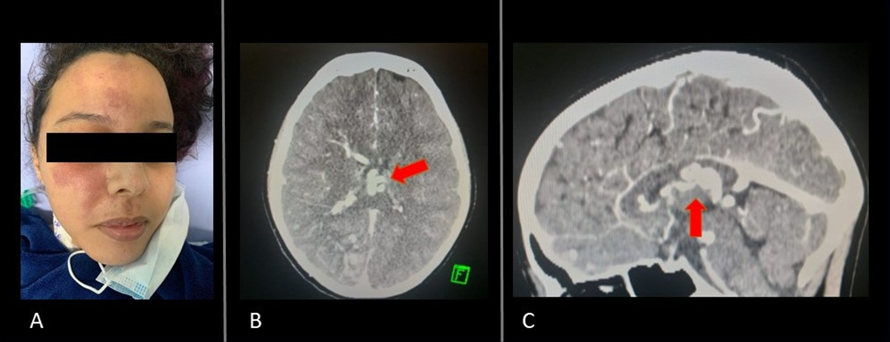 sturge weber mri