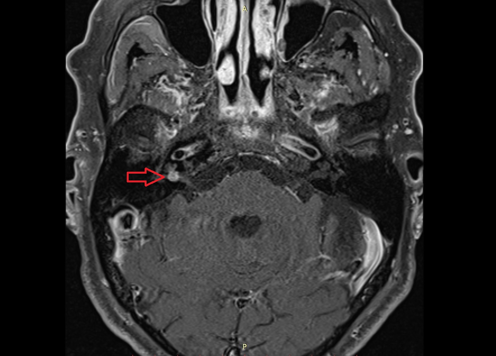 mri of internal auditory canal images which cranial