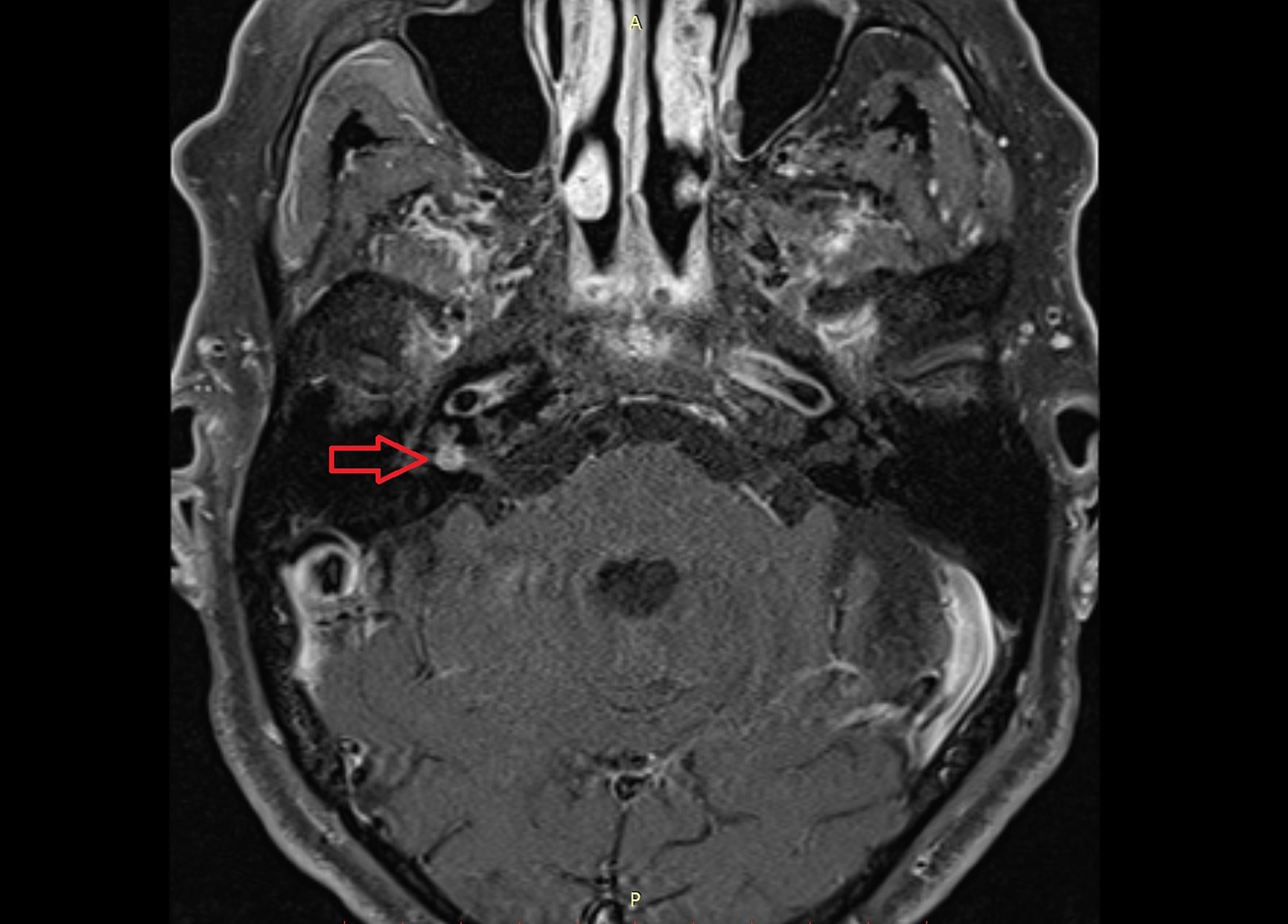 mri internal auditory canal cpt code