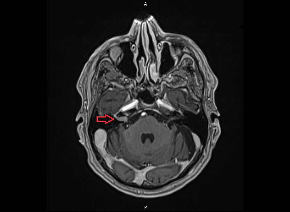 Cureus A Suspected Vestibular Schwannoma with Uncharacteristic Growth