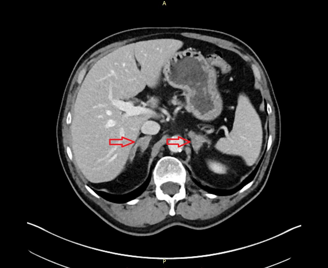 Cureus | A Suspected Vestibular Schwannoma with Uncharacteristic Growth ...