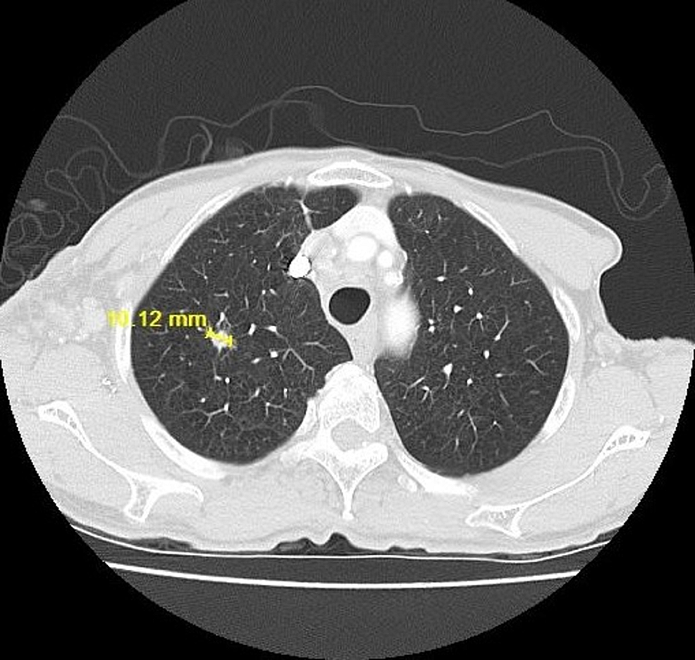 CT-chest-lung-window-showing-right-upper-lobe-nodule-on-06/12/2017