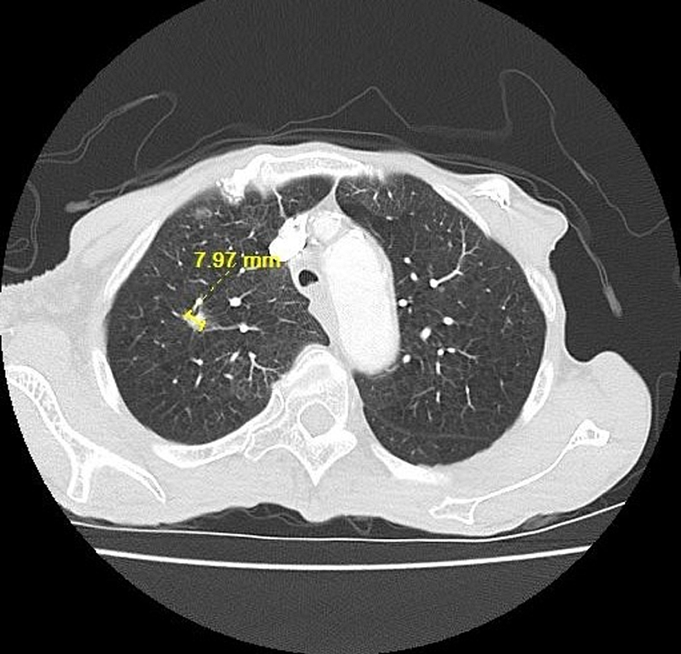 CT-chest-lung-window-showing-right-upper-lobe-lung-nodule-during-chemotherapy-on-11/27/2017