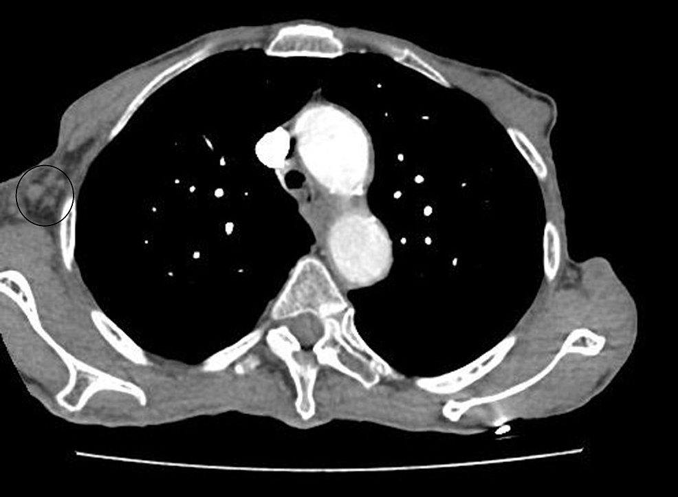-CT-chest-soft-tissue-window-showing-resolving-enlarged-right-axillary-lymph-nodes--(marked-with-a-black-circle)-during-chemotherapy-on-11/27/2017