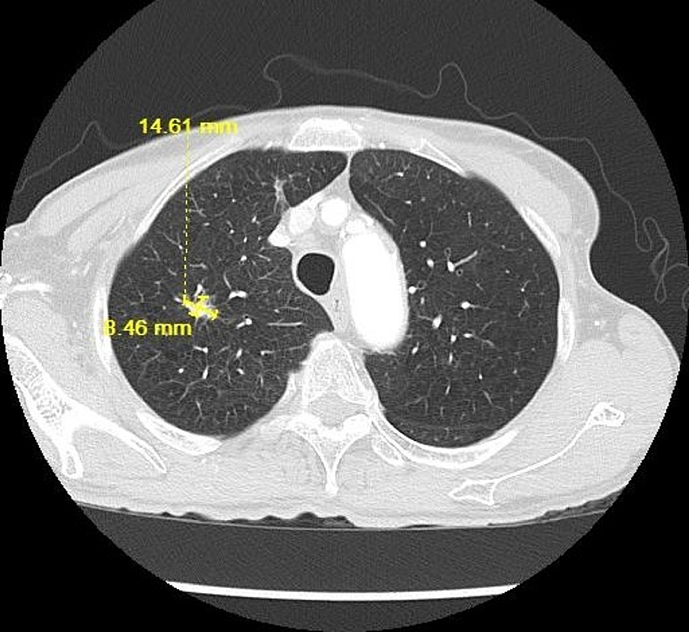 CT-chest-lung-window-showing-the-increased-size-of-the-lung-nodule-to-14.61-x-8.46-mm-on-03/12/2018