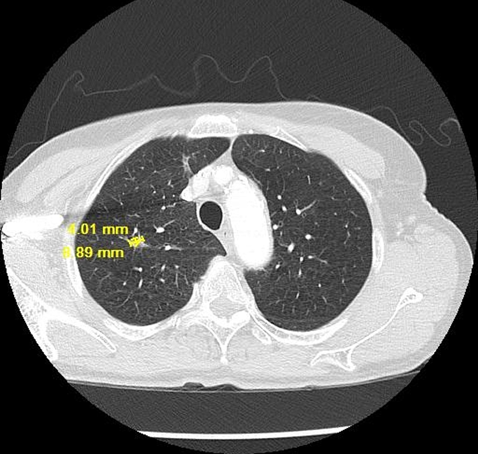CT-chest-lung-window-showing-resolving-lung-nodule-on-10/26/2018