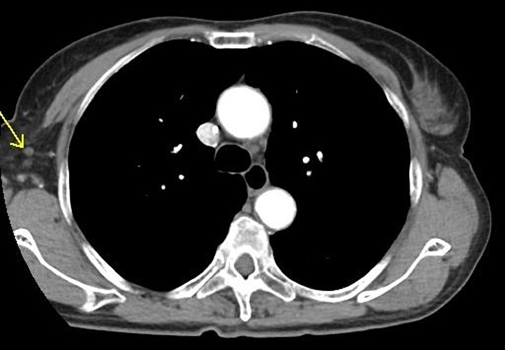 CT-chest-soft-tissue-window-showing-resolution-of-right-axillary-lymphadenopathy-on-10/26/2018