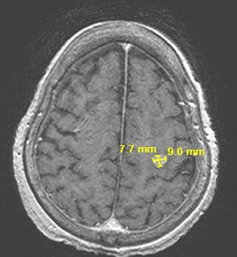 MRI-brain-showing-incidental-brain-metastatic-lesion-on-07/08/2021