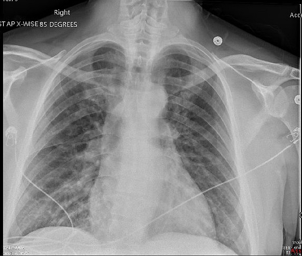 Widened Mediastinum Cxr Aortic Dissection