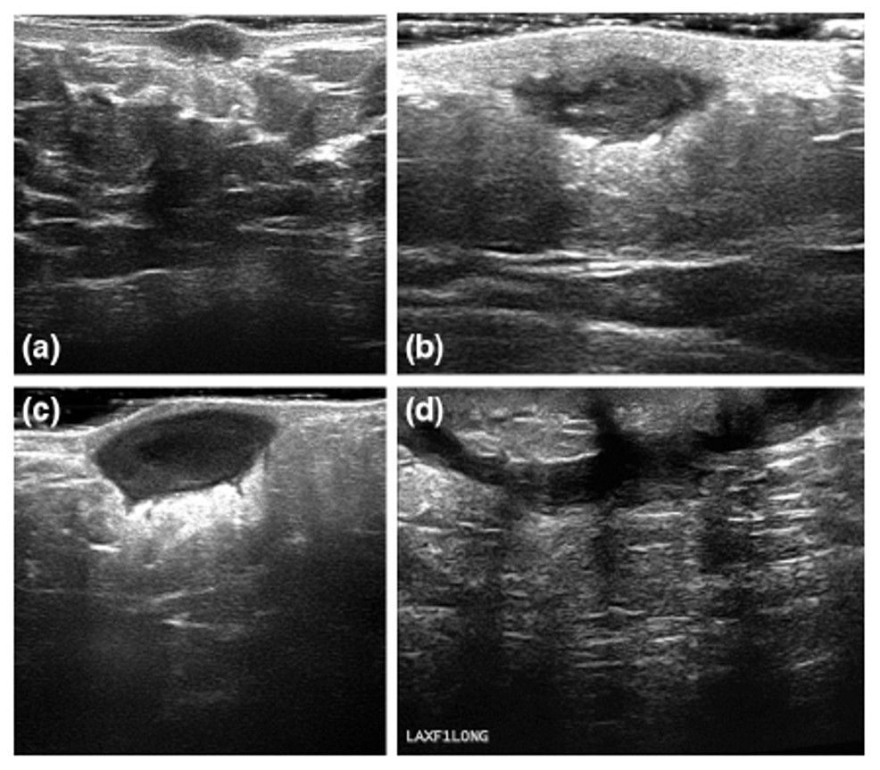 Cureus | Hidradenitis Suppurativa at an Uncommon Site: A Review of Its ...