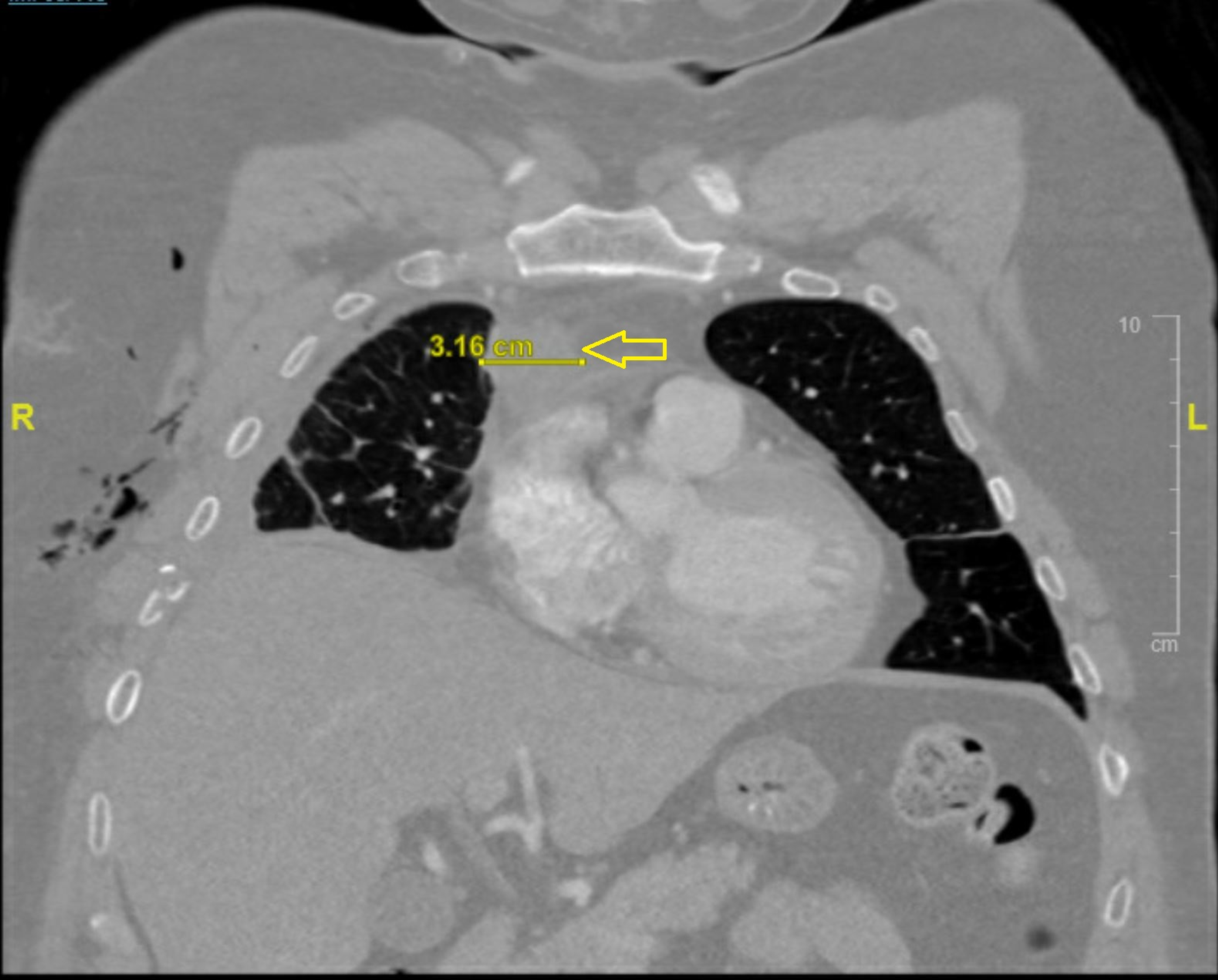 Cureus Cushing’s Syndrome Due to a Functional Thymic Neuroendocrine