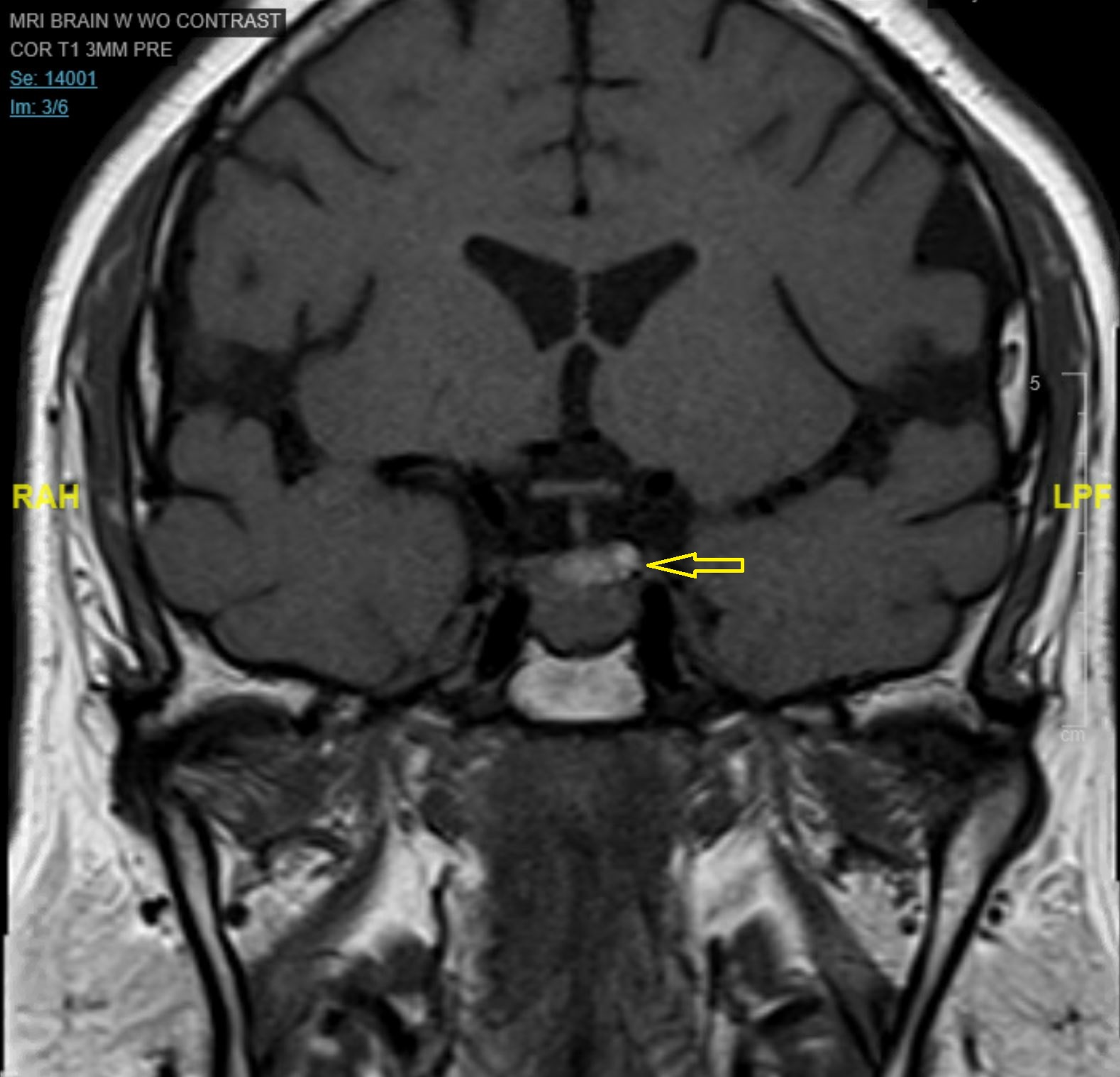 Cureus Cushing’s Syndrome Due to a Functional Thymic Neuroendocrine Tumor in Multiple