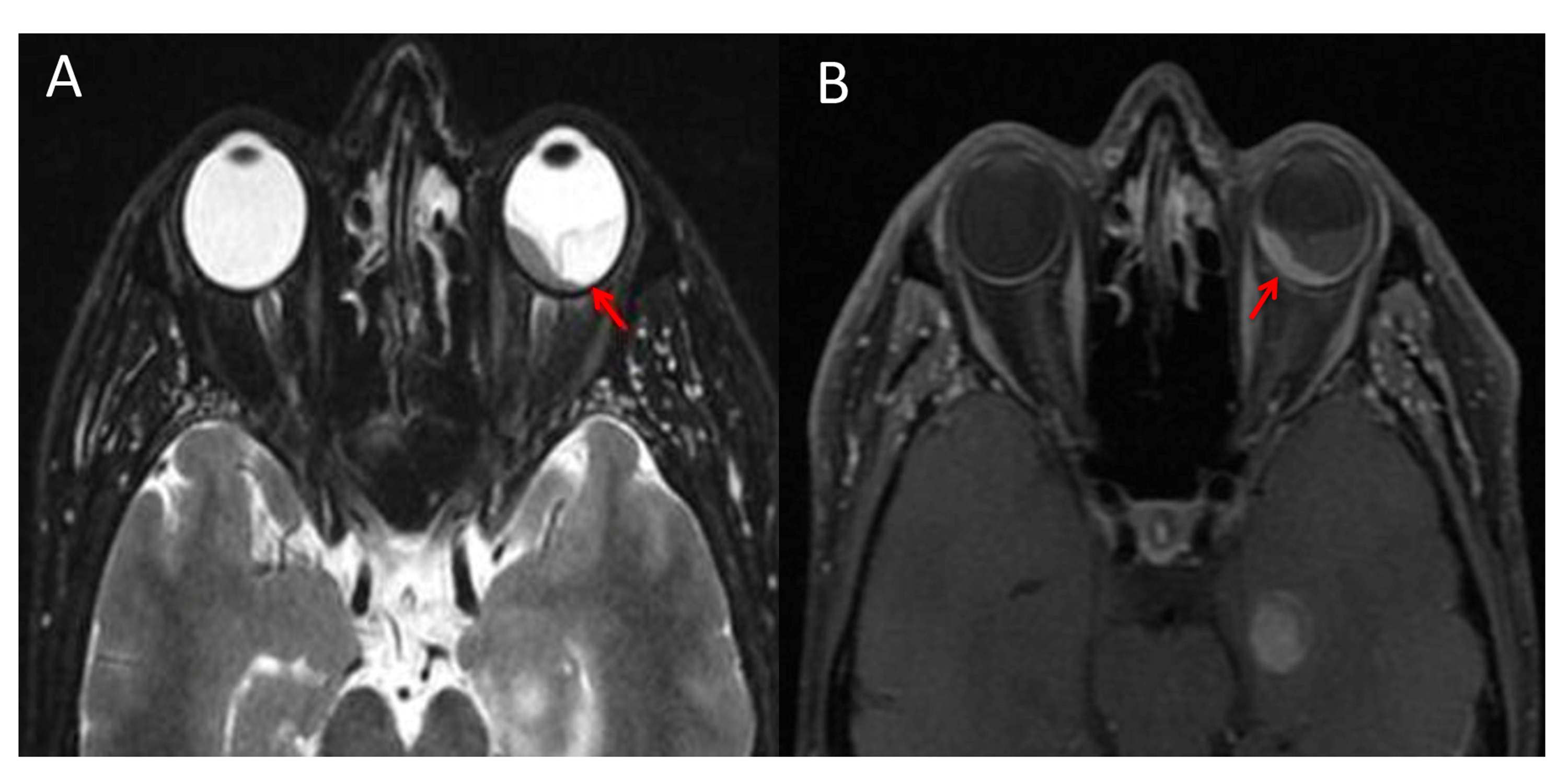 Cureus | Choroidal Metastasis Revealing A Lung Adenocarcinoma: A Case ...