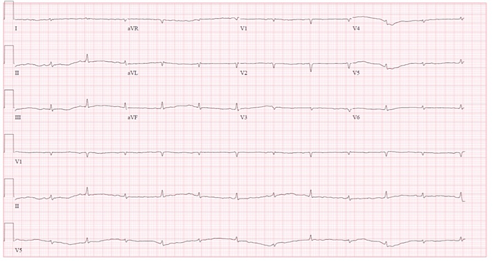 EKG-on-admission-showing-sinus-rhythm-with-low-voltage-QRS-complexes-with-electrical-alternans