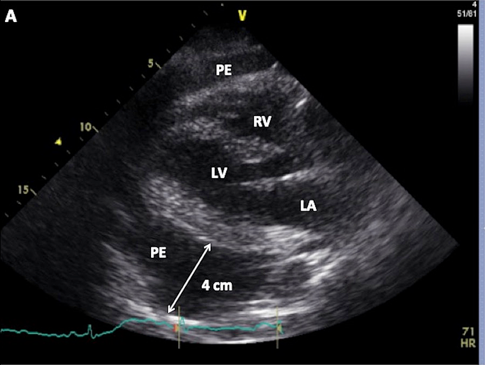 Echocardiographic-image-taken-in-the-parasternal-long-axis-view-demonstrates-a-large-pericardial-effusion-up-to-4-cm