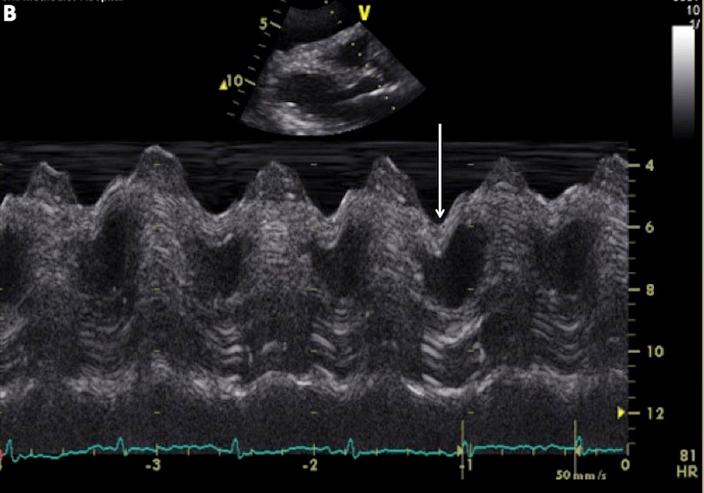M-mode-echocardiogram-image-in-the-parasternal-long-axis-view-demonstrates-the-right-ventricle-diastolic-collapse-(arrow)