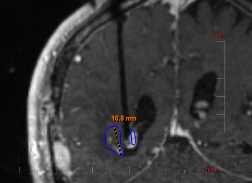 A SingleInstitution Retrospective Study of Patients Treated With LaserInterstitial Thermal