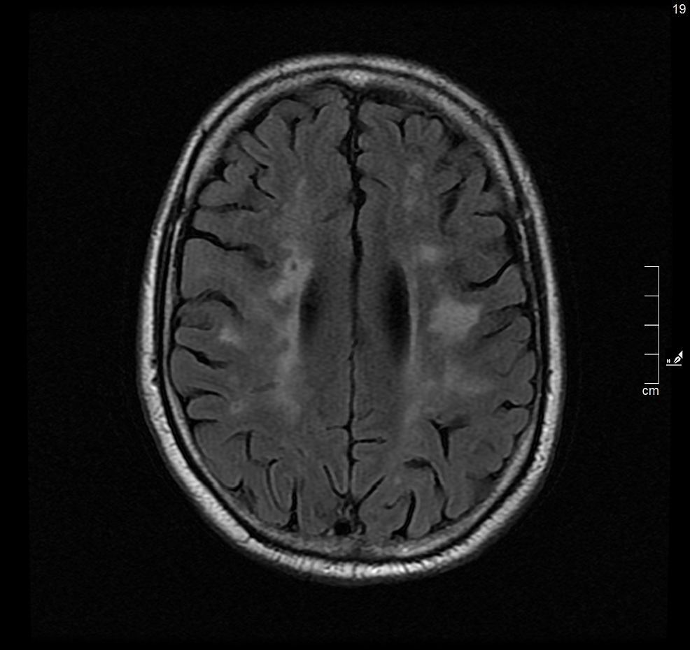 MRI-of-the-brain---FLAIR-T2-sequence---diffuse-changes-in-the-periventricular-and-deep-subcortical-white-matter