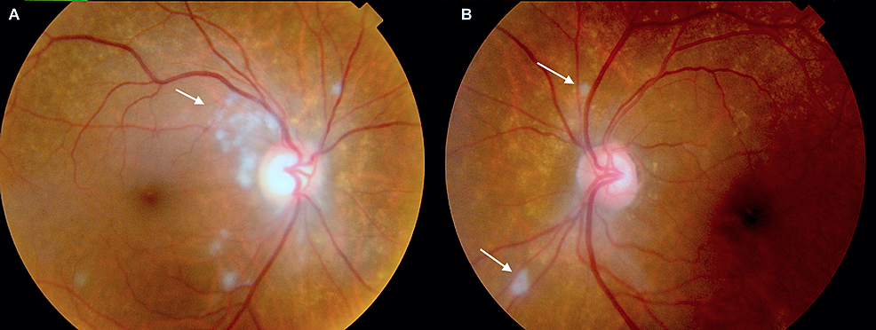 Fundus-photo-of-the-patient's-right-and-left-optic-nerves.