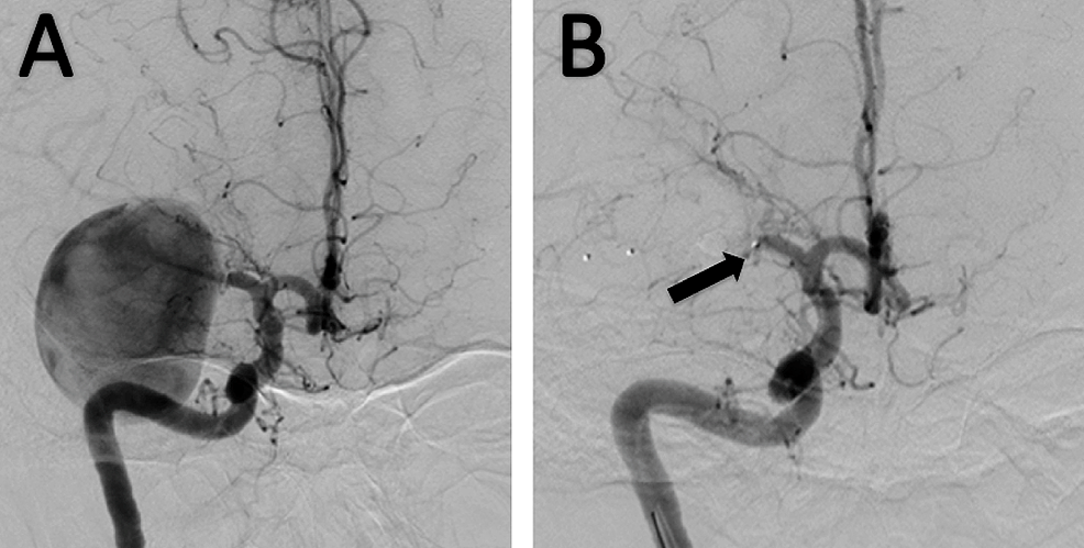 Stent-assisted Embolization of a Giant Aneurysm of the Middle Cerebral ...