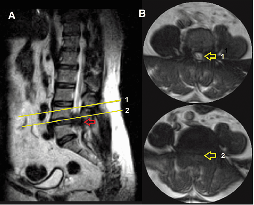 MRI-of-the-lumbar-spine.-Sagittal-(A)-and-axial-(B)-views-in-T2-sequence.