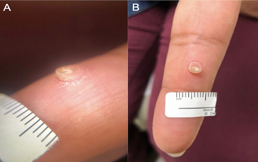 exophytic-nodule-on-the-finger-cureus