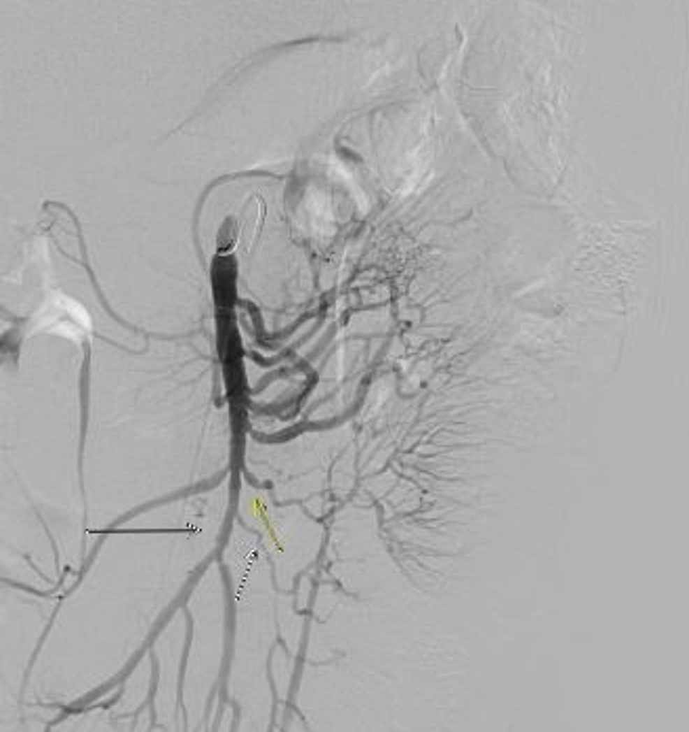 cureus-isolated-multifocal-superior-mesenteric-artery-vasculitis-with