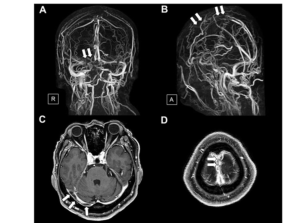 Magnetic-resonance-venography-and-brain-MRI-with-gadolinium-enhancement-on-admission