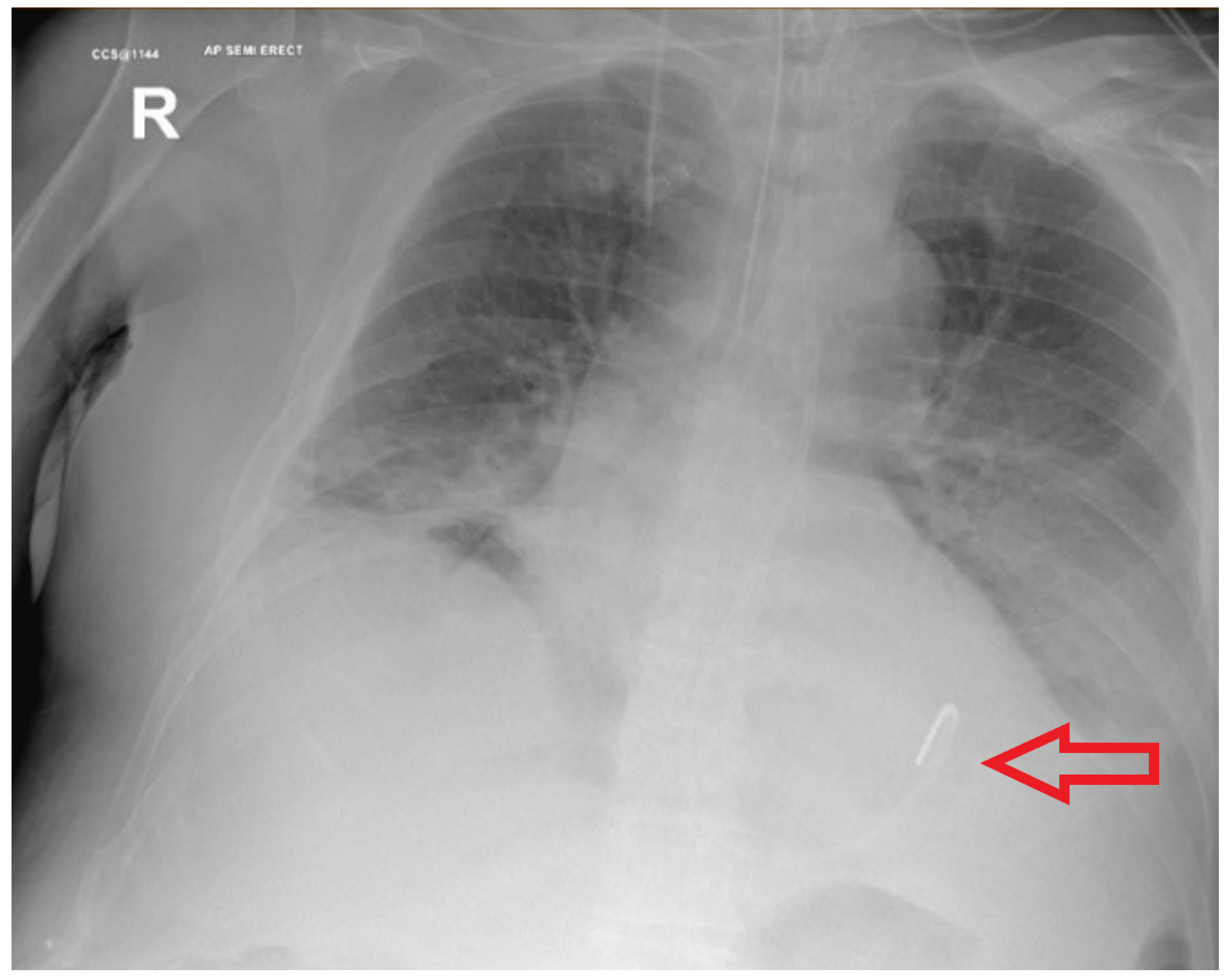 Cureus Delayed Adult Gastric Perforation Following Insertion Of A Feeding Nasogastric Tube
