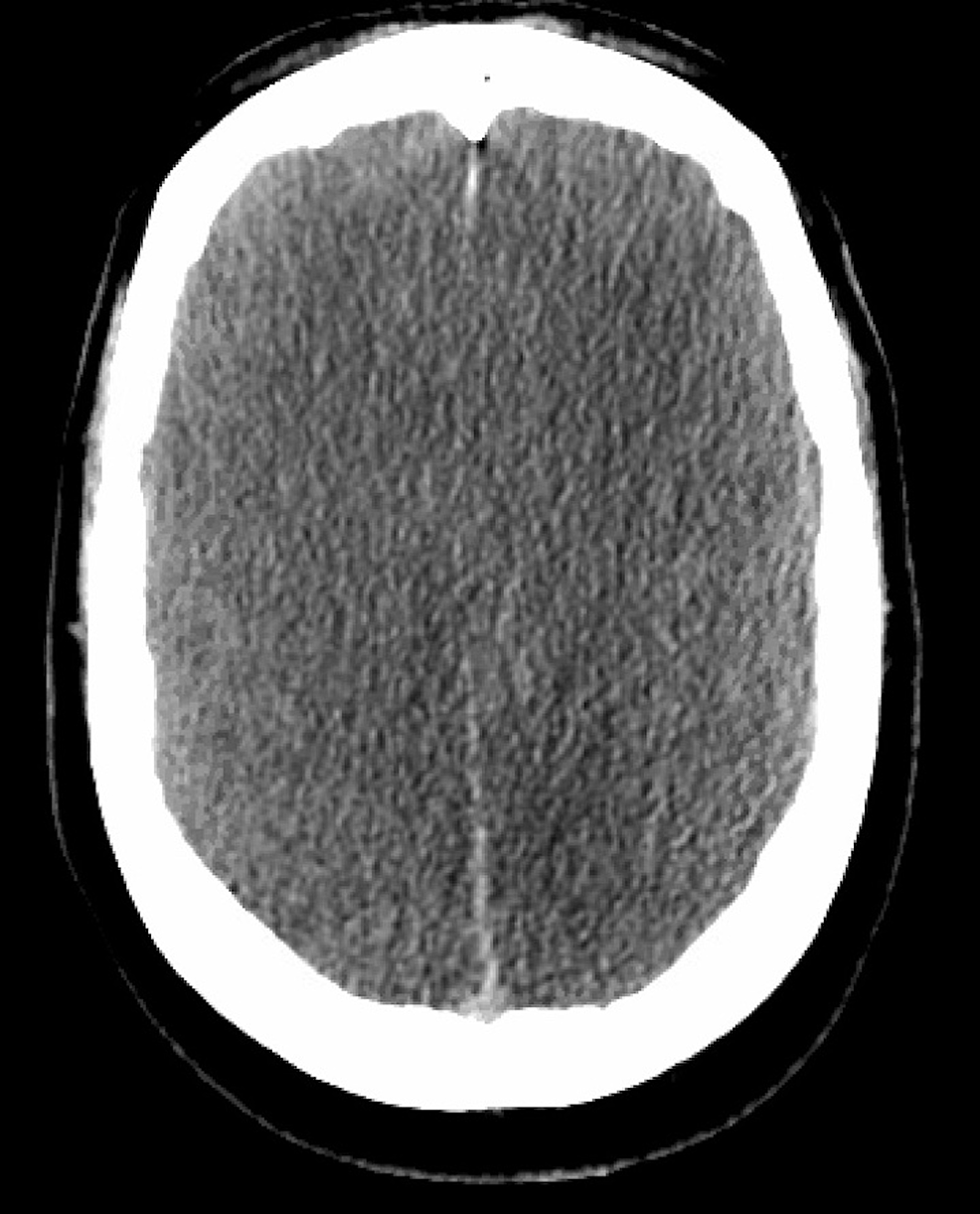 Cureus Brash Syndrome Leading To Cardiac Arrest And Diffuse Anoxic