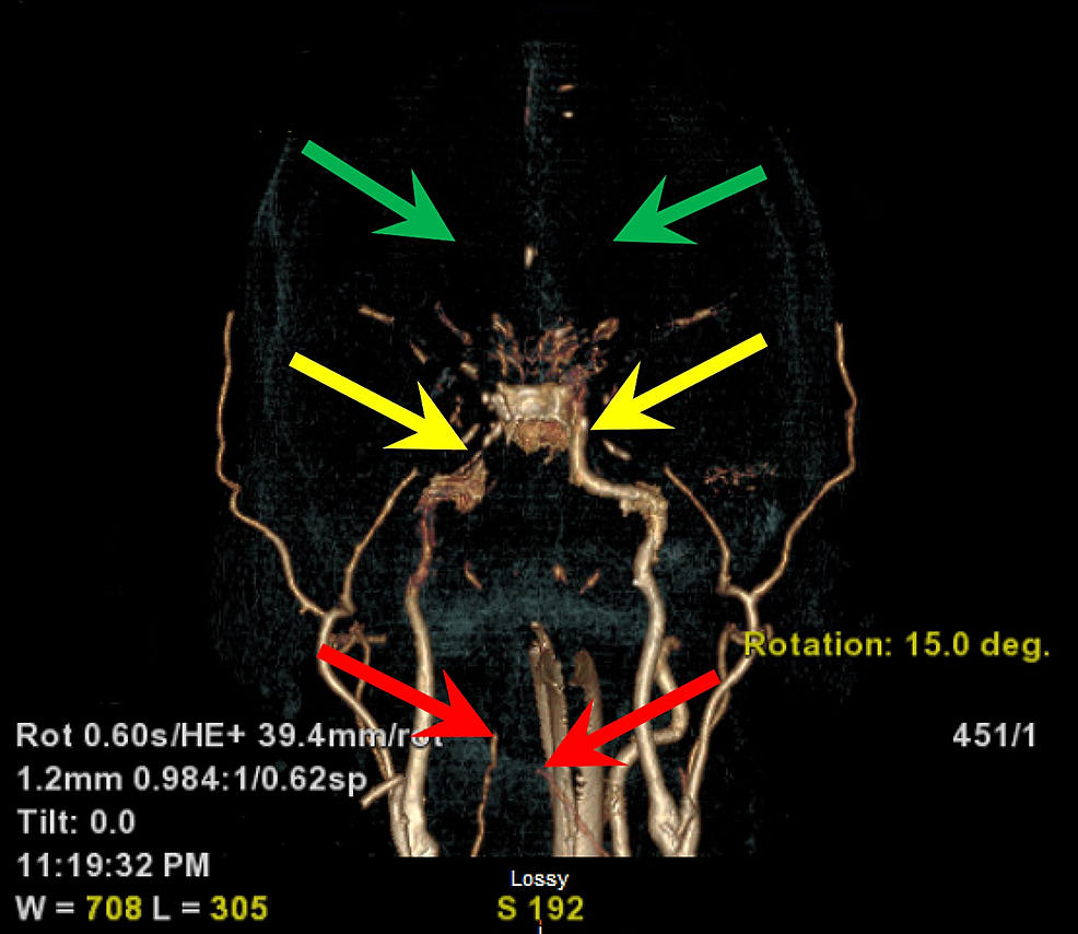 Cureus BRASH Syndrome Leading to Cardiac Arrest and Diffuse Anoxic