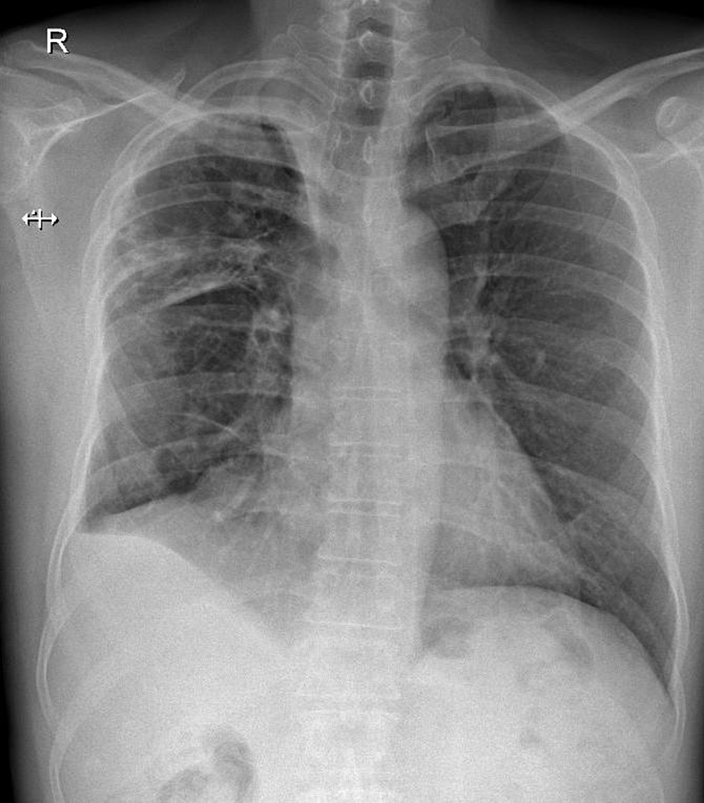 Cureus | Silent Dyspnea: Spontaneous Pneumomediastinum in a Heroin User