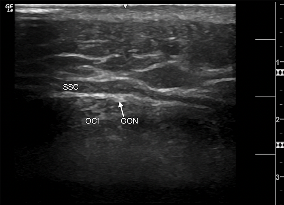 Left-sided-greater-occipital-nerve-(GON)-seen-with-high-frequency-linear-ultrasound-probe