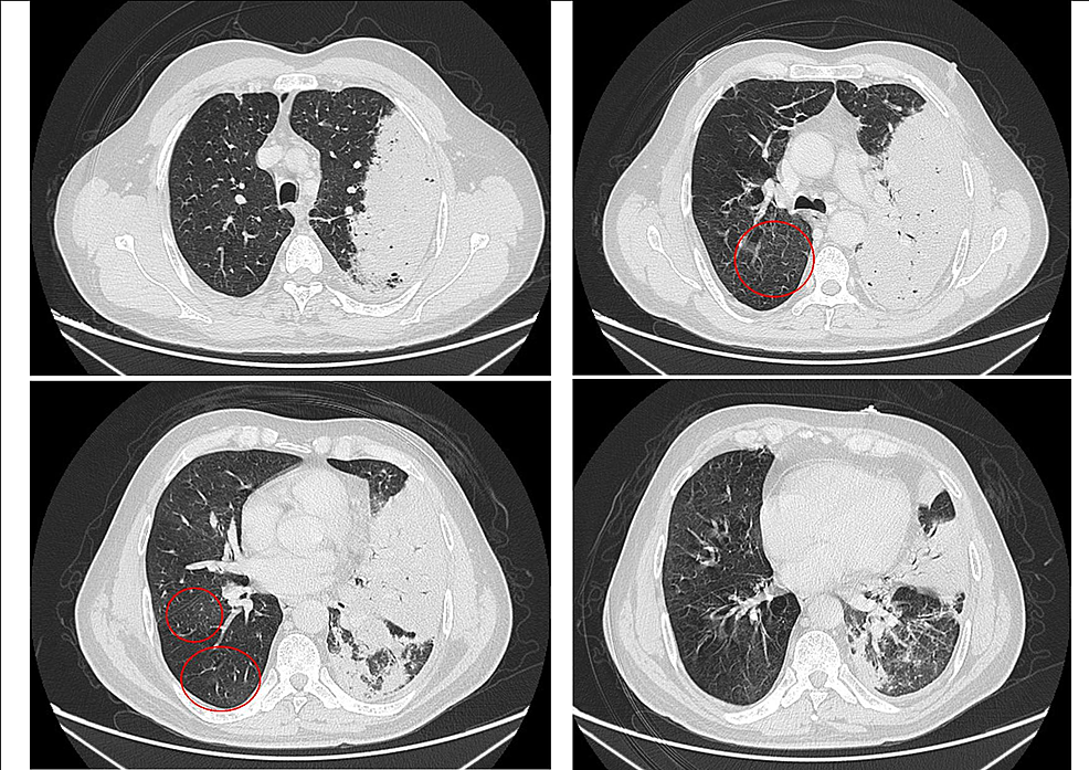 CT-scan-of-the-chest-showing-the-opacity-extending-over-the-left-lung-with-ground-glass-foci-in-the-right-lung-during-hospital-admission