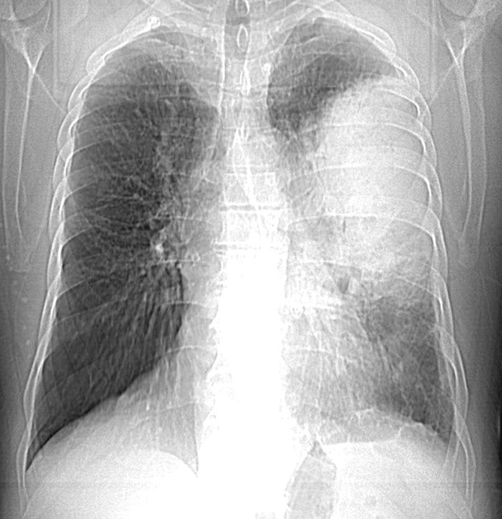 First-chest-X-ray-showing-alveolitis-type-shadowing-taking-up-two-thirds-of-the-left-lung