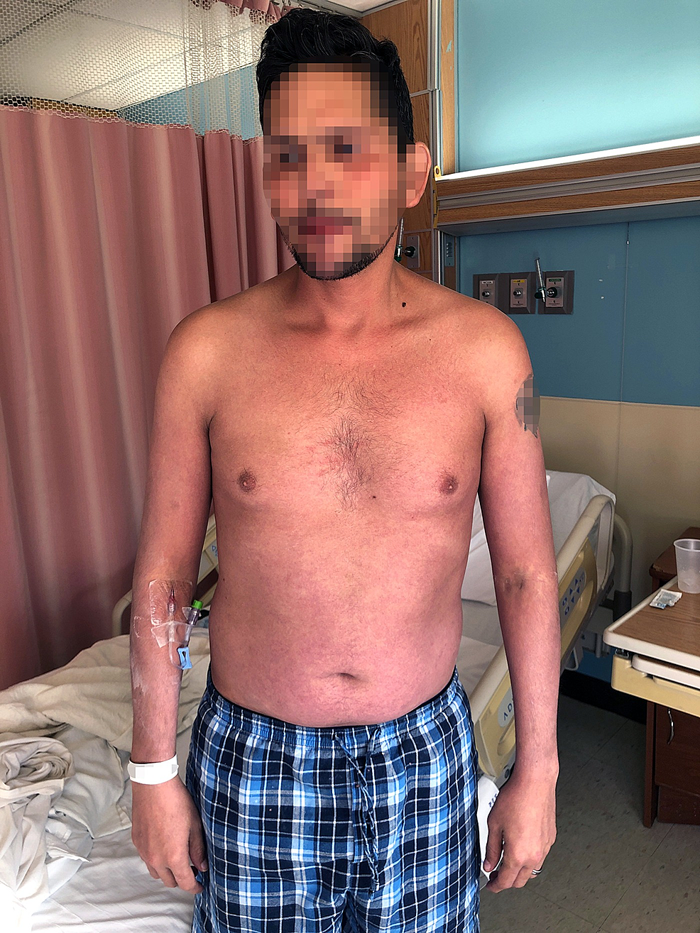 New-erythematous-maculopapular-rash-on-the-face,-bilateral-arms,-chest,-and-abdomen.