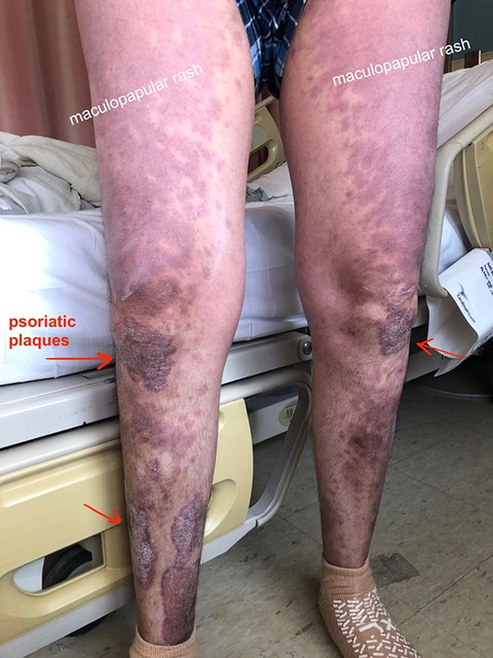Maculopapular-rash-on-the-lower-extremities-with-acutely-worsening-plaque-psoriasis.