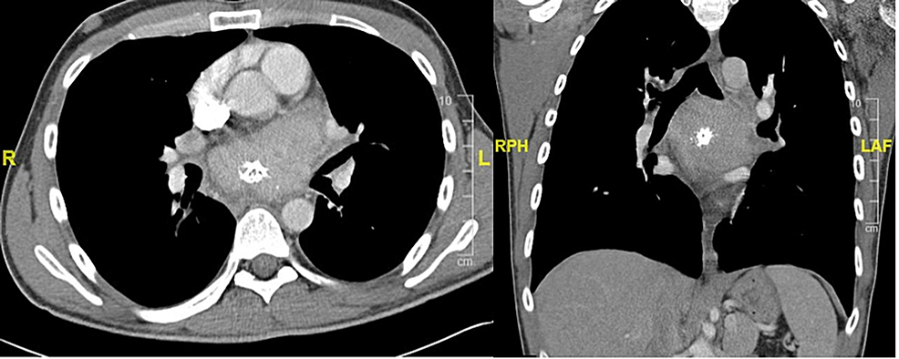 Castleman Disease Presenting As A Mediastinal Mass 