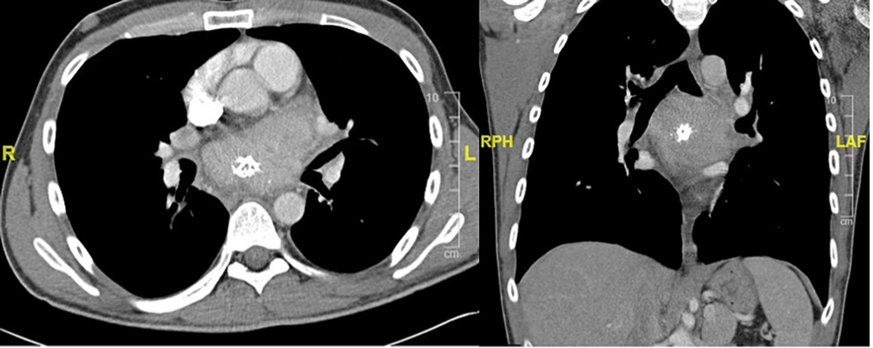 Castleman Disease Presenting as a Mediastinal Mass | Cureus