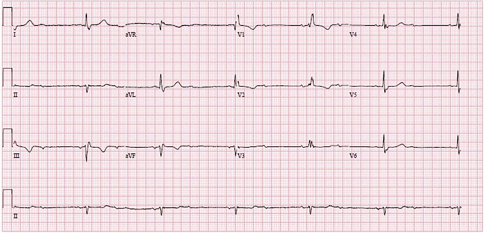 A-12-lead-ECG-showing-evidence-of-LAFB,-RBBB,-and-2:1-AV-conduction-block.