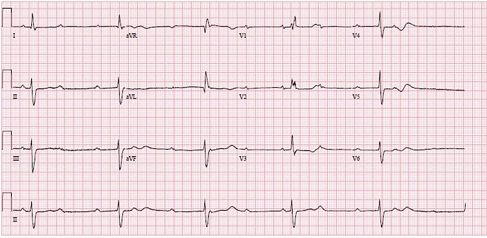 A-12-lead-ECG-showing-evidence-of-CHB.