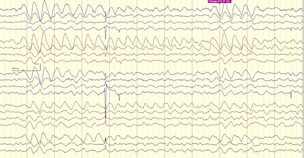 Cureus | Intermittent Frontal Rhythmic Discharges as an ...