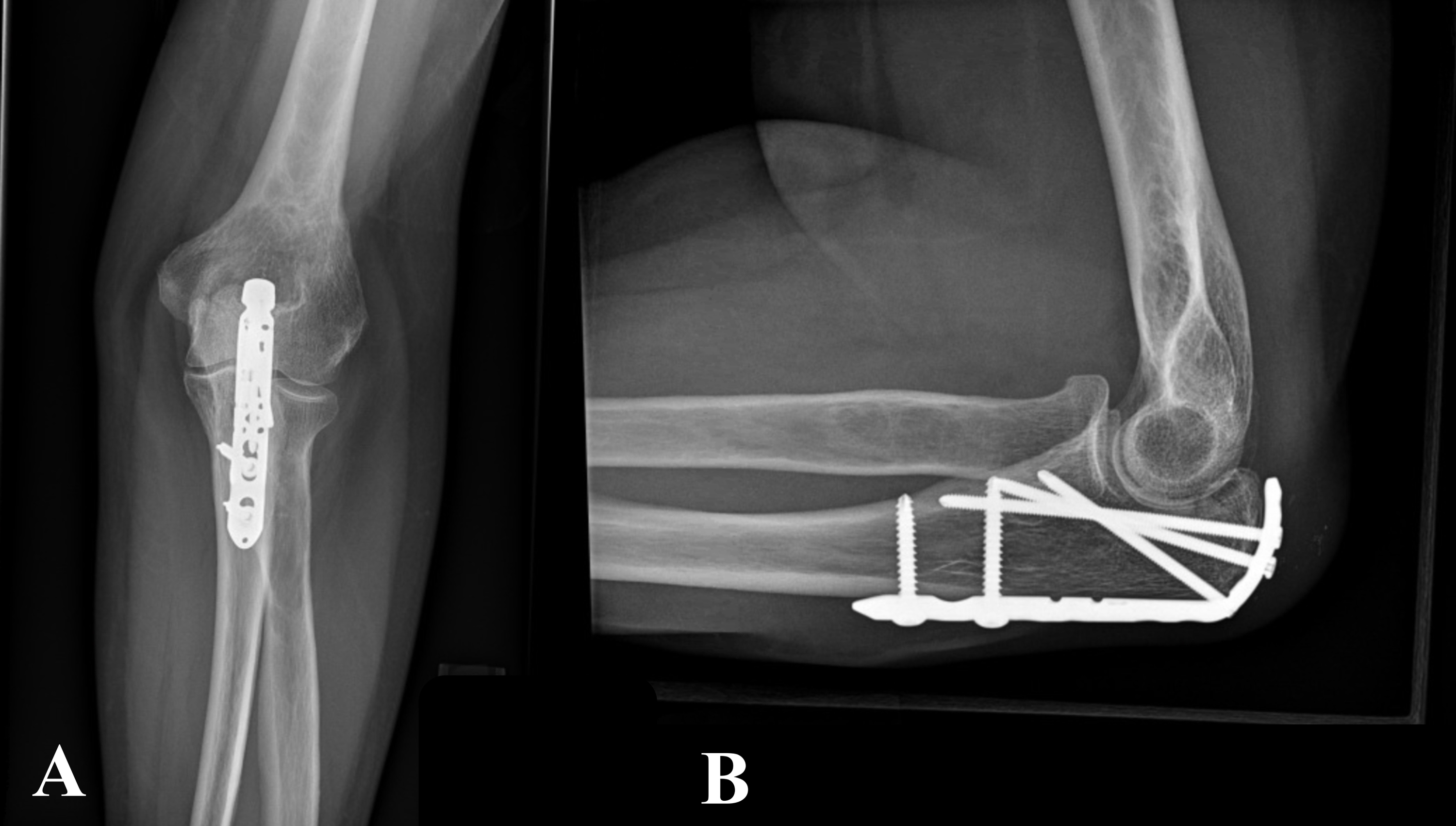 Olecranon Fracture Physiopedia Vrogue Co